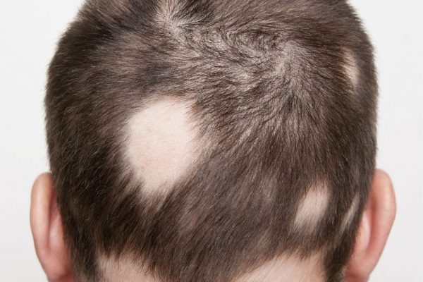 alopecia-areata